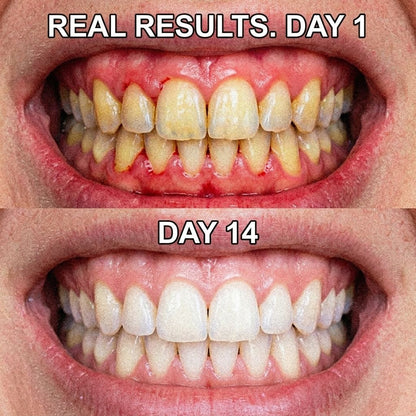 🚨 DENTISTS ARE LYING TO YOU: The Real Reason Your Teeth Are Rotting (It's NOT Just Smoking) 🛑-QDL